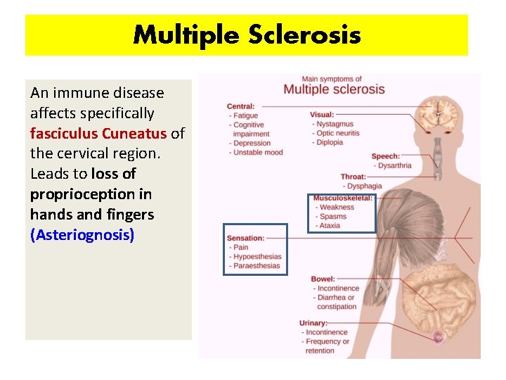 Multiple Sclerosis An immune disease affects specifically fasciculus Cuneatus of the cervical region. Leads