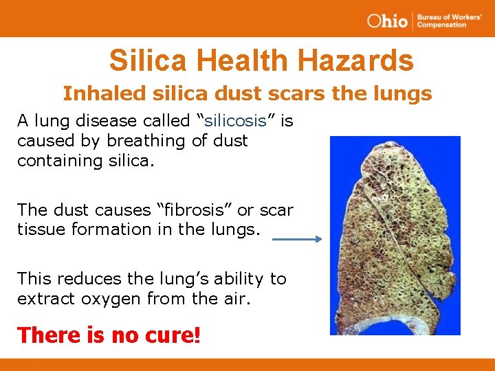 Silica Health Hazards Inhaled silica dust scars the lungs A lung disease called “silicosis”