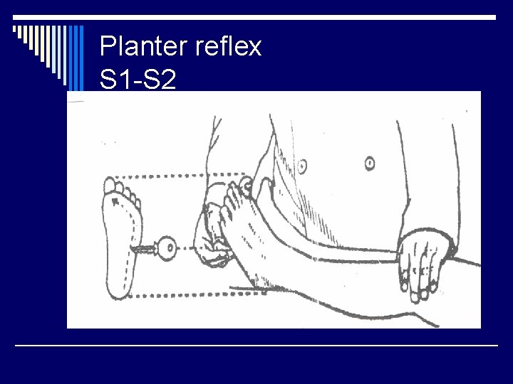 Planter reflex S 1 -S 2 