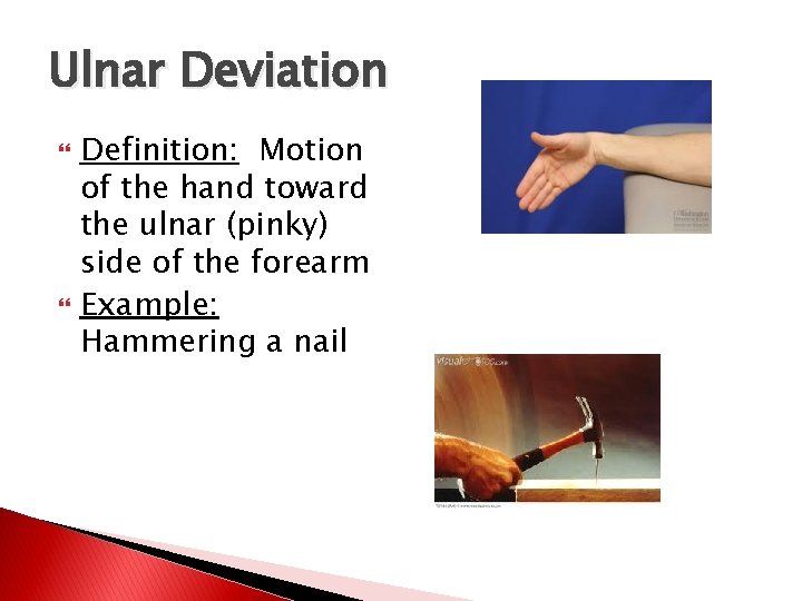 Ulnar Deviation Definition: Motion of the hand toward the ulnar (pinky) side of the