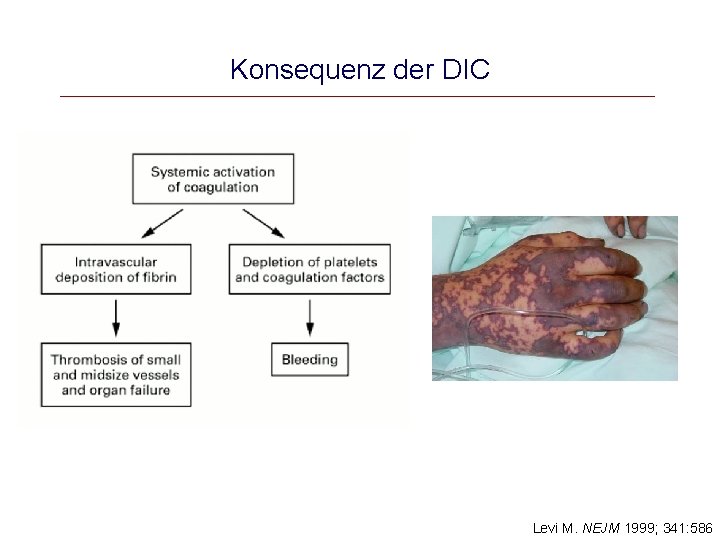 Konsequenz der DIC Levi M. NEJM 1999; 341: 586 