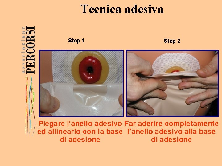 Tecnica adesiva Step 1 Step 2 Piegare l’anello adesivo Far aderire completamente ed allinearlo