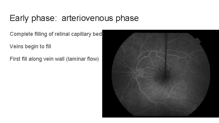 Early phase: arteriovenous phase Complete filling of retinal capillary bed Veins begin to fill