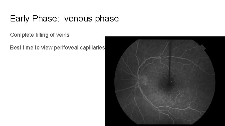 Early Phase: venous phase Complete filling of veins Best time to view perifoveal capillaries