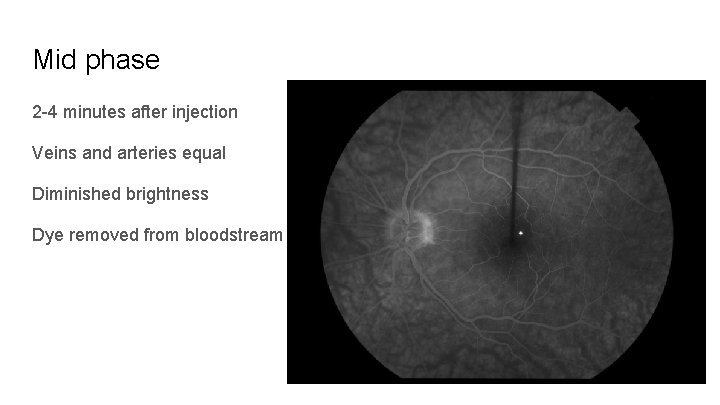 Mid phase 2 -4 minutes after injection Veins and arteries equal Diminished brightness Dye