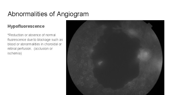 Abnormalities of Angiogram Hypofluorescence *Reduction or absence of normal fluorescence due to blockage such