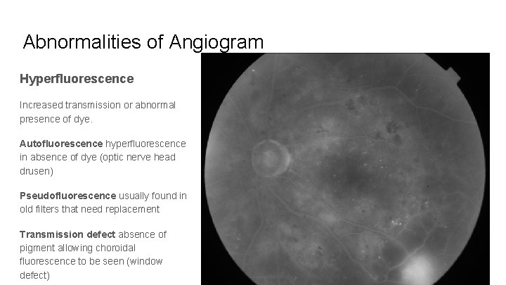 Abnormalities of Angiogram Hyperfluorescence Increased transmission or abnormal presence of dye. Autofluorescence hyperfluorescence in