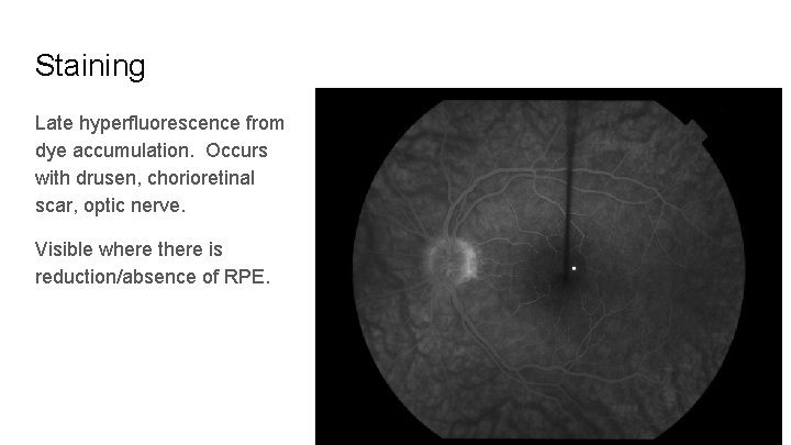 Staining Late hyperfluorescence from dye accumulation. Occurs with drusen, chorioretinal scar, optic nerve. Visible