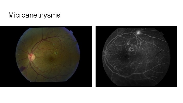 Microaneurysms 