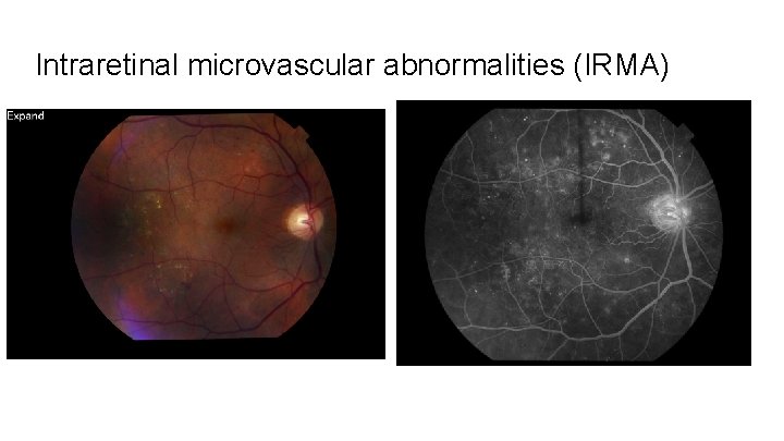 Intraretinal microvascular abnormalities (IRMA) 