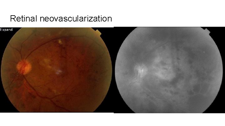 Retinal neovascularization 