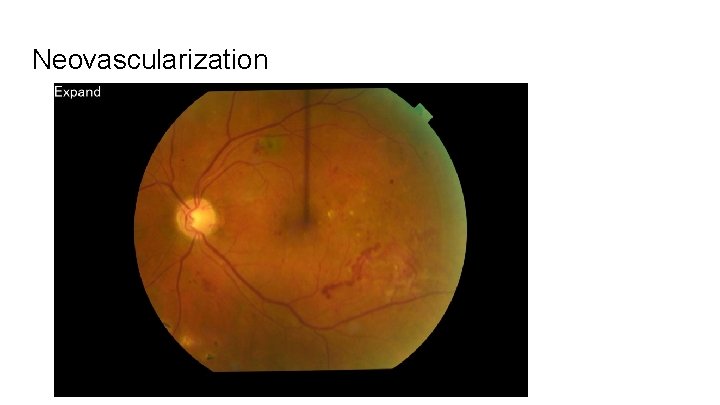 Neovascularization 