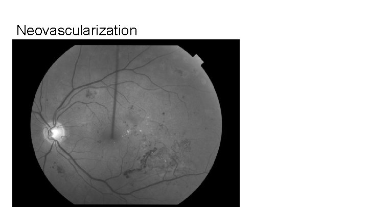 Neovascularization 