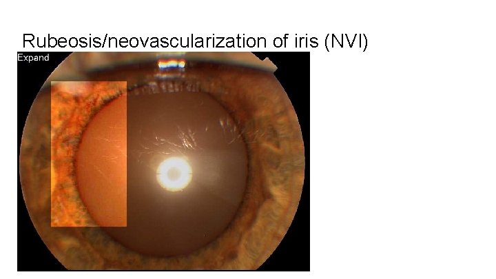 Rubeosis/neovascularization of iris (NVI) 