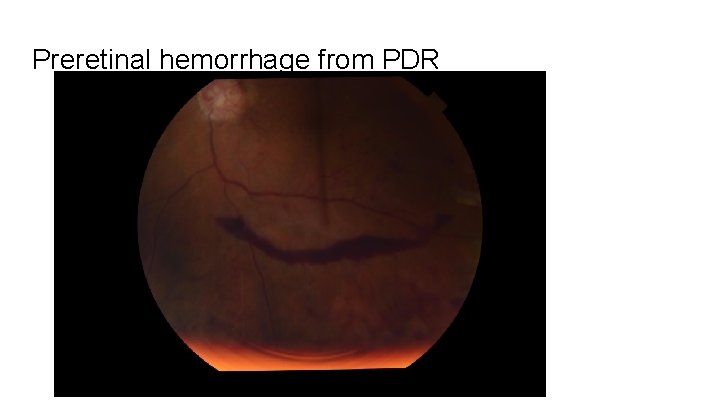 Preretinal hemorrhage from PDR 