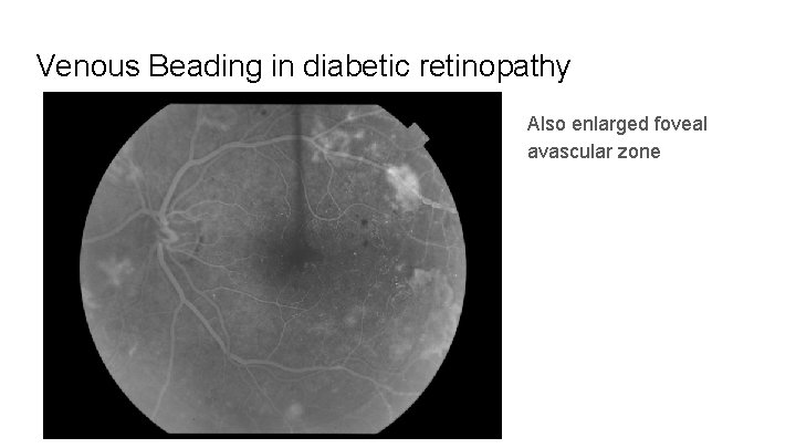 Venous Beading in diabetic retinopathy Also enlarged foveal avascular zone 