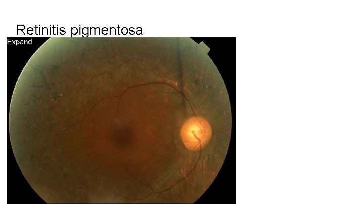 Retinitis pigmentosa 