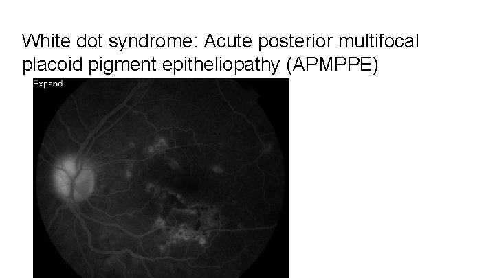 White dot syndrome: Acute posterior multifocal placoid pigment epitheliopathy (APMPPE) 