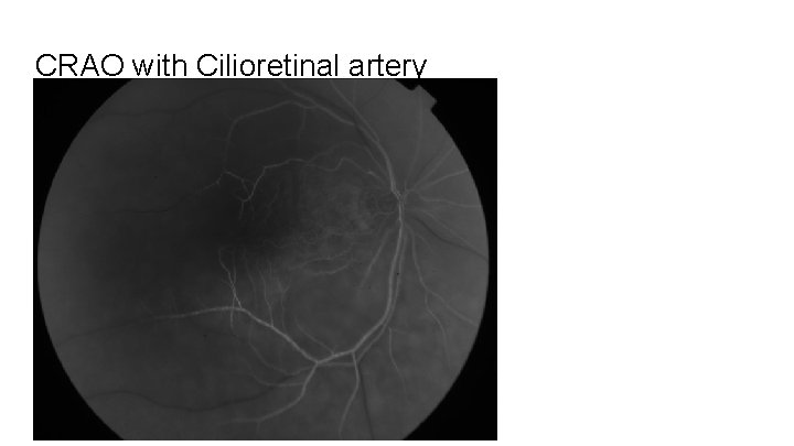 CRAO with Cilioretinal artery 