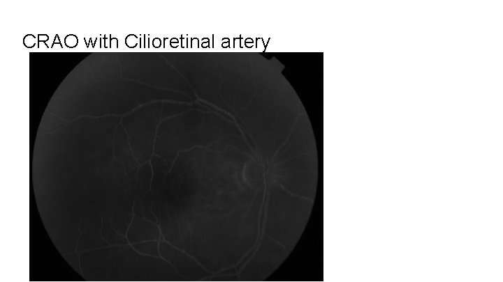 CRAO with Cilioretinal artery 