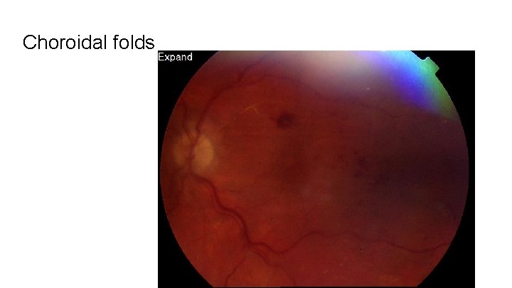 Choroidal folds 
