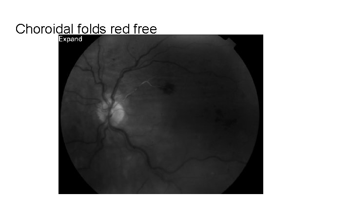 Choroidal folds red free 