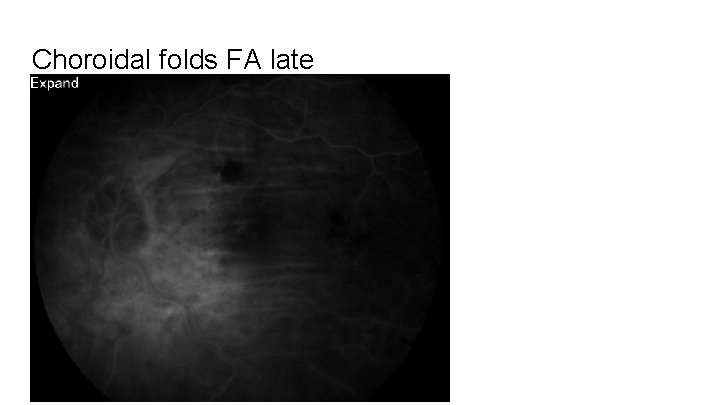 Choroidal folds FA late 