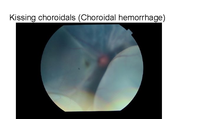 Kissing choroidals (Choroidal hemorrhage) 