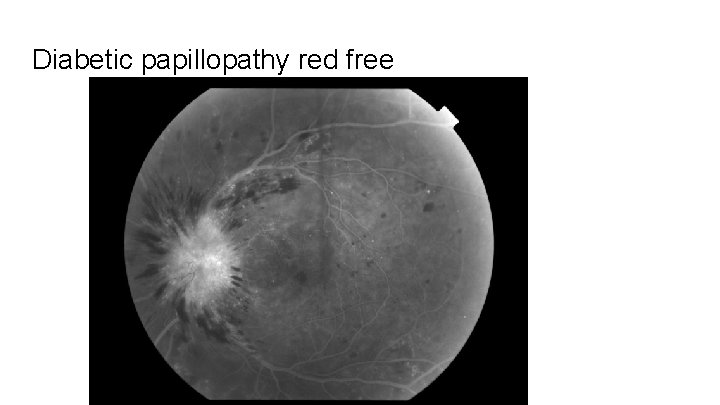 Diabetic papillopathy red free 