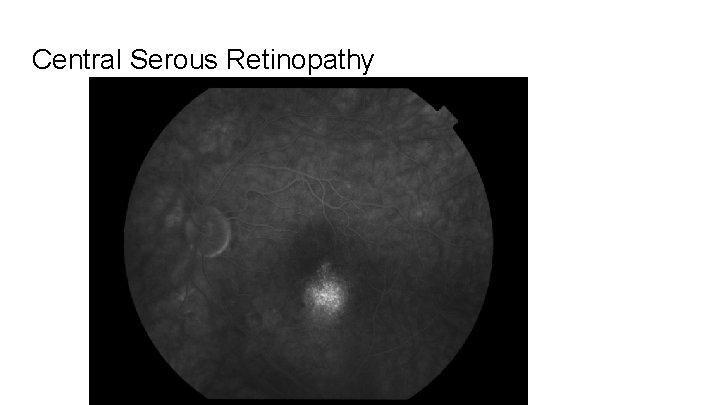 Central Serous Retinopathy 