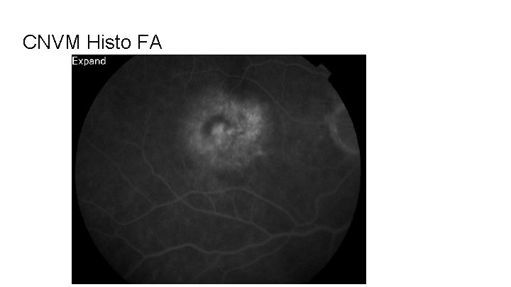 CNVM Histo FA 