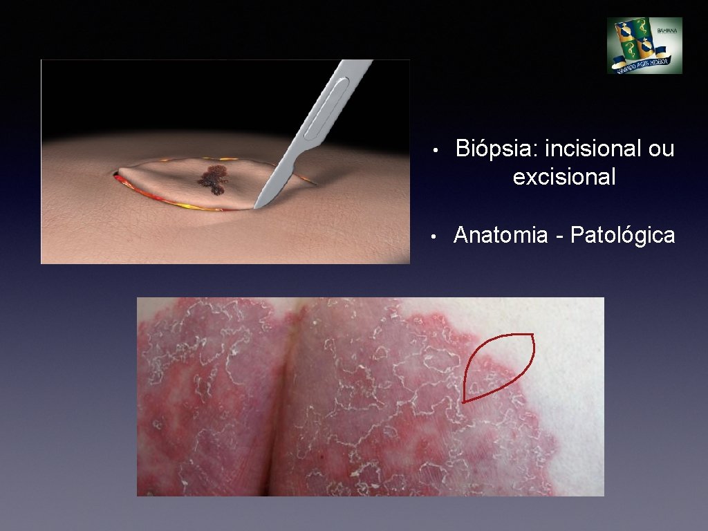  • Biópsia: incisional ou excisional • Anatomia - Patológica 