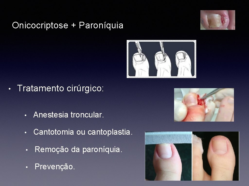 Onicocriptose + Paroníquia • Tratamento cirúrgico: • Anestesia troncular. • Cantotomia ou cantoplastia. •
