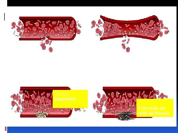 Lesão vascular Vasoconstrição Tampão plaquetário Formação da rede de fibrinas 