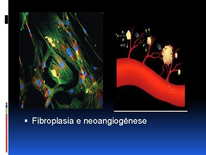  Fibroplasia e neoangiogênese 