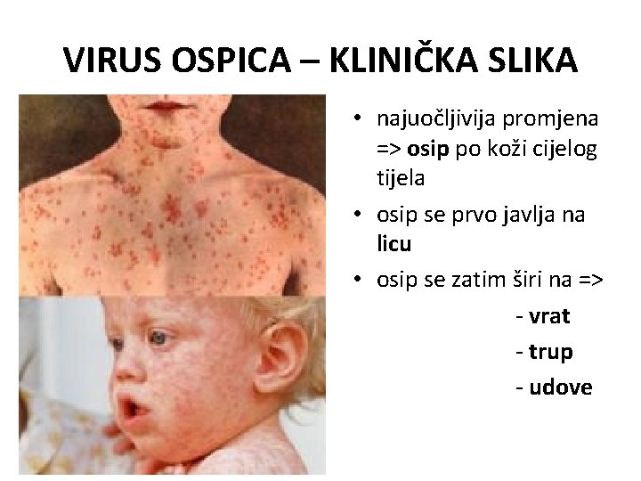 VIRUS OSPICA – KLINIČKA SLIKA • najuočljivija promjena => osip po koži cijelog tijela