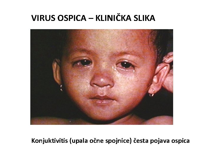 VIRUS OSPICA – KLINIČKA SLIKA Konjuktivitis (upala očne spojnice) česta pojava ospica 