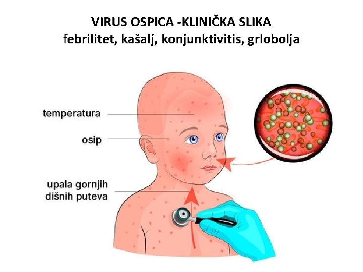 VIRUS OSPICA -KLINIČKA SLIKA febrilitet, kašalj, konjunktivitis, grlobolja 