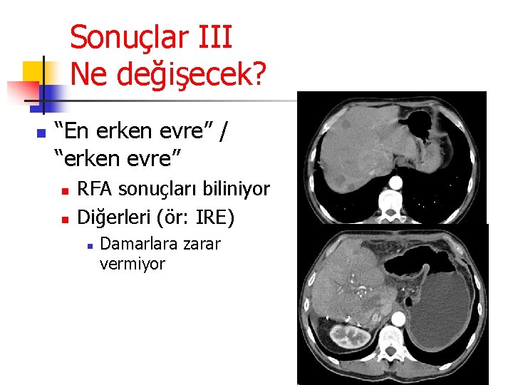 Sonuçlar III Ne değişecek? n “En erken evre” / “erken evre” n n RFA