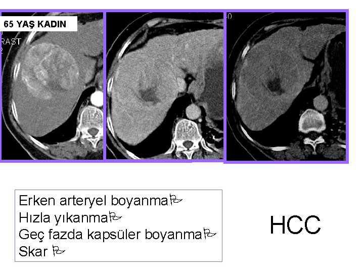 65 YAŞ KADIN Erken arteryel boyanma Hızla yıkanma Geç fazda kapsüler boyanma Skar HCC