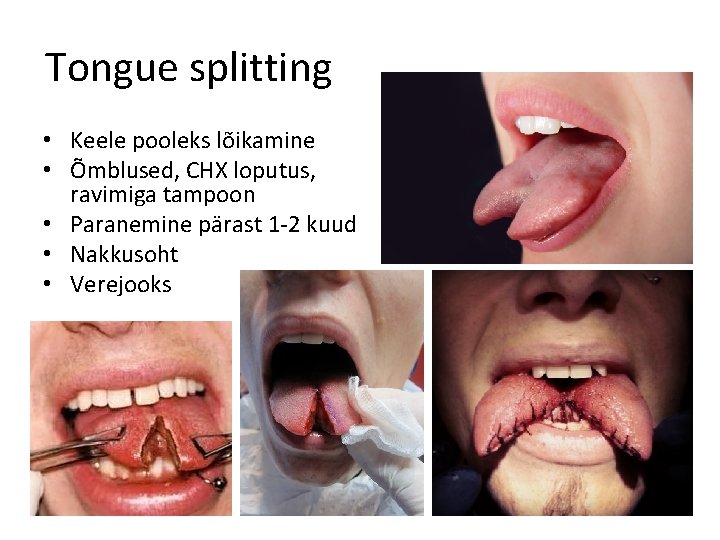 Tongue splitting • Keele pooleks lõikamine • Õmblused, CHX loputus, ravimiga tampoon • Paranemine