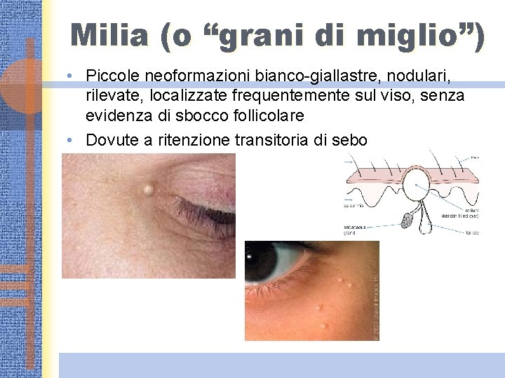 Milia (o “grani di miglio”) • Piccole neoformazioni bianco-giallastre, nodulari, rilevate, localizzate frequentemente sul