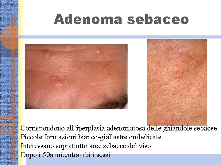 Adenoma sebaceo Corrispondono all’iperplasia adenomatosa delle ghiandole sebacee Piccole formazioni bianco-giallastre ombelicate Interessano soprattutto