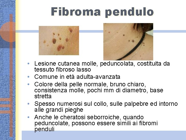Fibroma pendulo • Lesione cutanea molle, peduncolata, costituita da tessuto fibroso lasso • Comune