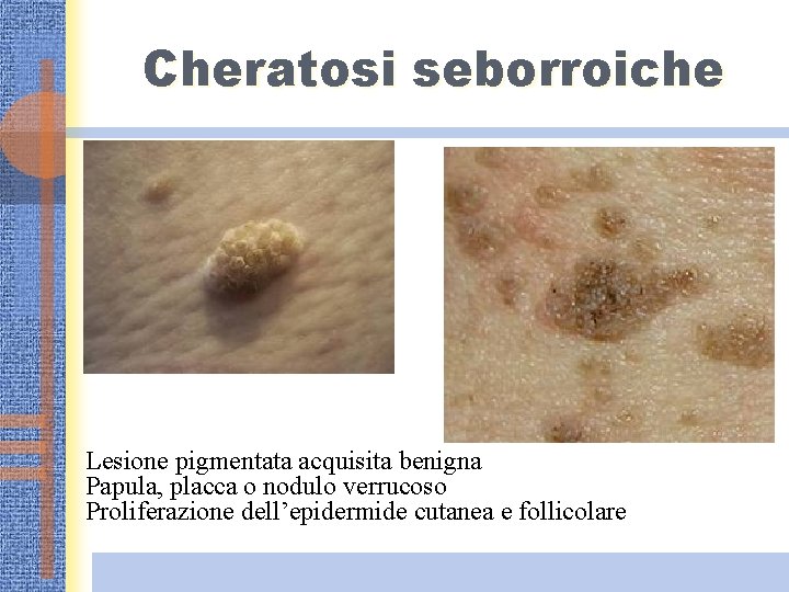 Cheratosi seborroiche Lesione pigmentata acquisita benigna Papula, placca o nodulo verrucoso Proliferazione dell’epidermide cutanea