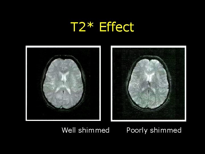 T 2* Effect Well shimmed Poorly shimmed 