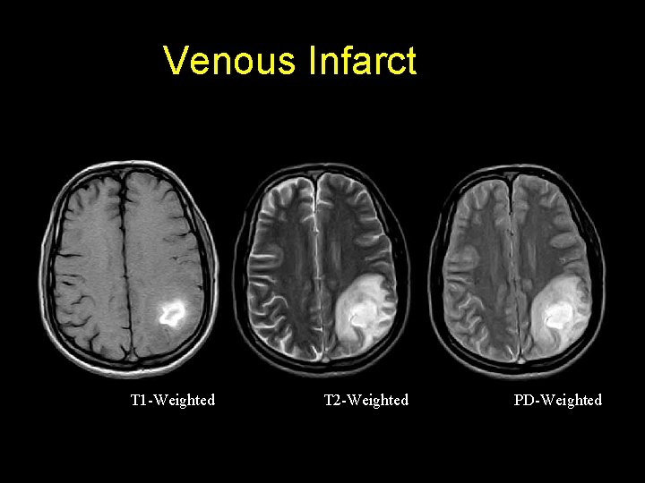 Venous Infarct T 1 -Weighted T 2 -Weighted PD-Weighted 