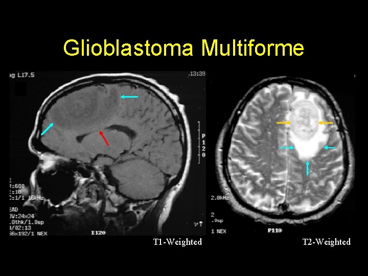 Glioblastoma Multiforme T 1 -Weighted T 2 -Weighted 