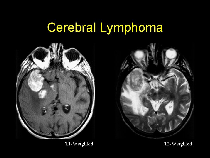 Cerebral Lymphoma T 1 -Weighted T 2 -Weighted 