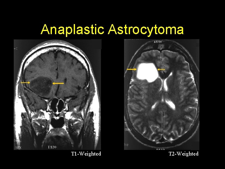 Anaplastic Astrocytoma T 1 -Weighted T 2 -Weighted 